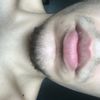 Lippenlifting(bullhornexcision) (Verkürzung des Philtrums)
