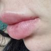 Lippen Unterspritzung schiefgegangen