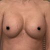 Implantat oval und auf anderer Seite rund