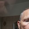 Nach  Oberlidstraffung