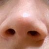 Nasenflügel schmälern - welche Möglichkeiten?