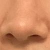 Nasenflügel schmälern - welche Möglichkeiten?