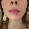 Revolax Lippen Schwangerschaft