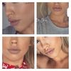 Wie viel Hyaluron für recht volle Lippen?