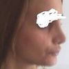 Knochen zwischen Auge und Nase 1 Monat post Nasenkorrektur