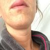 Plötzliche Schwellung an Oberlippe 5 Monate nach Lippenvergrößerung