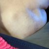 Was tun gegen Wellen und Falten nach Mastektomie und Sofortaufbau?