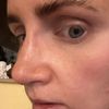 Seitliche Delle 3 Wochen nach Rhinoplastik