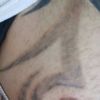 Tattooentfernung mit dermabrassion (brust) 