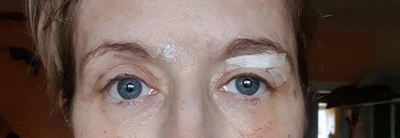 Unvollständiger Lidschluss nach Oberlidstraffung, Mopsblick