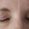 Trockene Augen 3 Monate nach Oberlidstraffung