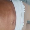 BAUCH LIPO, Verhärtungen am bauch
