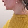 Doppelkinn entfernt mit Liposuktion?