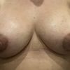 Senkt sich das Implantat noch?
