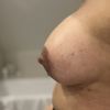 Senkt sich das Implantat noch?