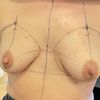 Senkt sich das Implantat noch?