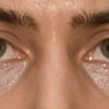 Behandlungsoptionen 8 Monate Post Unterlidstraffung