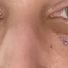 Behandlungsoptionen 8 Monate Post Unterlidstraffung