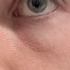 Behandlungsoptionen 8 Monate Post Unterlidstraffung
