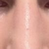 Behandlungsoptionen 8 Monate Post Unterlidstraffung
