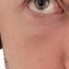 Behandlungsoptionen 8 Monate Post Unterlidstraffung
