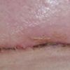 4 Wochen Post OP, Narbe okay?