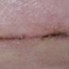 4 Wochen Post OP, Narbe okay?