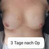 Implantat sitzt höher als das andere
