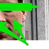 Hyaluron-Filler bei den Augen abgesackt. Fettpolster? UltraCol?