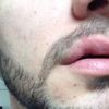 Narbe an der Lippe nach Unfall möglich zu beseitigen?