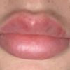 Hyaluron oder Schwellung nach Lippen Aufspritzen