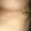 Silikonpflaster 13 Tage post Brustvergrößerung?