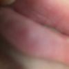 Hyaluron in der Lippe 1ml