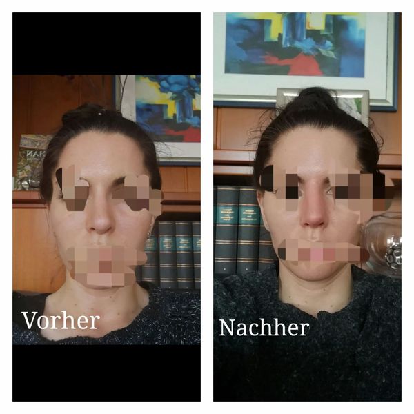 Nase nach 1 Jahr post OP geschwollen?!