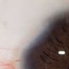 Blepharoplastik - Augen schließen nicht mehr (3M)