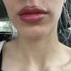 Lippendelle nach Hylase und anschließend Lipfiller