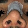 asymmetrisches Nasenlöcher 