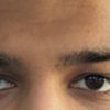 Die Haut über den Augen wird immer dicker und übt Druck auf den beiden oberen Augenlidern.