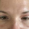 Wie kann ich die Heilung nach Augenlidstraffung unterstützen?