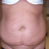 Bauchstraffung und Oberarmstraffung in einer OP?