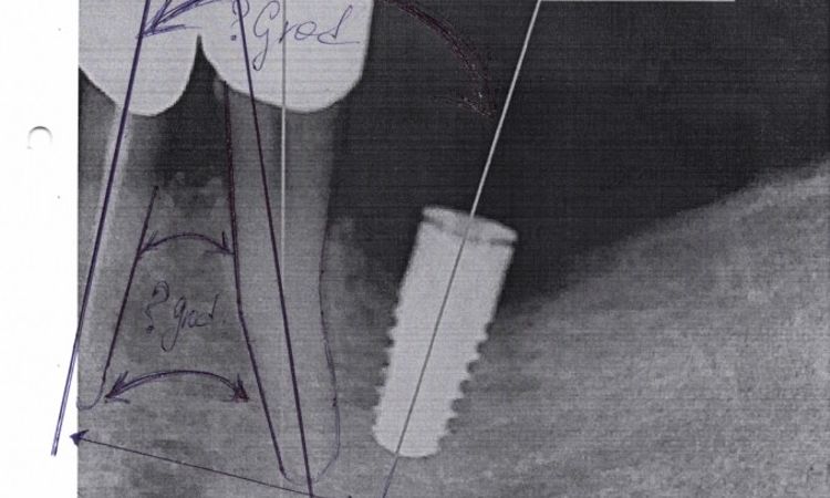 Zahnimplantat schief eingesetzt? - 25340