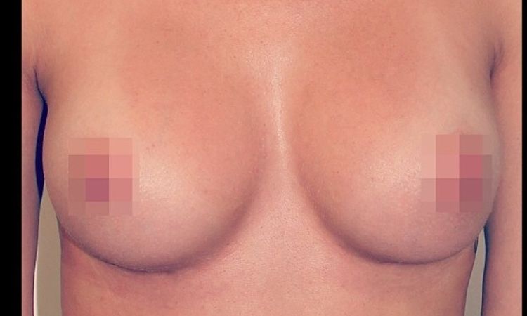 Brustvergrößerung HILFE - geeignete Implantatgröße - 25405