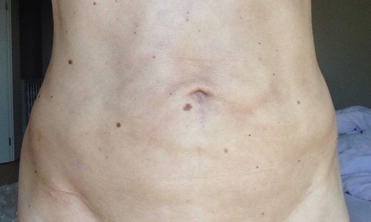 Verhärtung und andere Probleme 6 Monate nach Liposuktion - 25468
