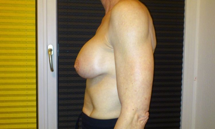 Waterfall deformity 6 wochen nach Brustvergrößerung? - 25475