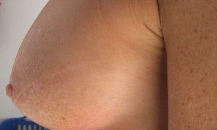 Brüste nach Brustvergrößerung unterschiedlich. Ist etwas schief gelaufen? - 25479