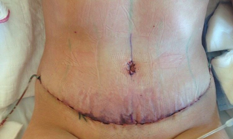 Kann die Haut nach Bauchdeckenstraffung absterben? - 25481