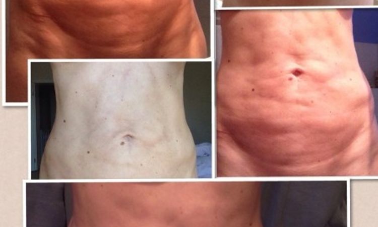 Nicht zufrieden mit Ergebnis nach Bauchliposuktion - 25496