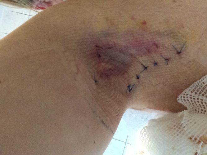 Schweissdrüsenabsaugung wundflüssigkeit nach 10 Tagen