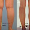 Liposuction Waden / Fesseln - 25581