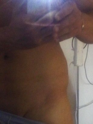 unzufriedenstellendes Ergebnis nach Laserlipolyse an den Hüften